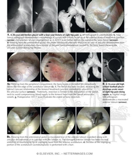 Femoroacetabular Impingement