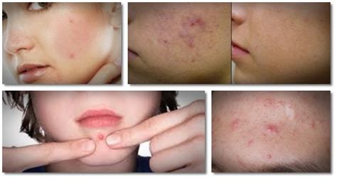 Nodules are one of the inflammatory acne lesions that appear and spread on the skin during severe acne breakouts. Best Foundation For Sensitive Skin With Rosacea Nose