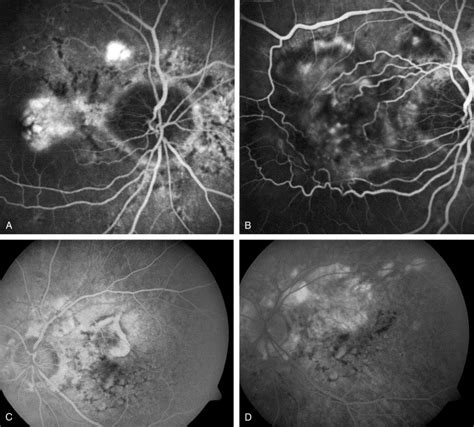 Therapeutic Strategies In Choroidal Neovascularizations Secondary To