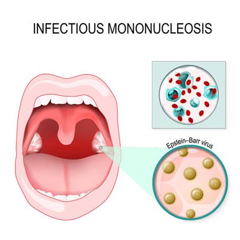 Infectious Mononucleosis The Main Signs Of The Disease Eat Right