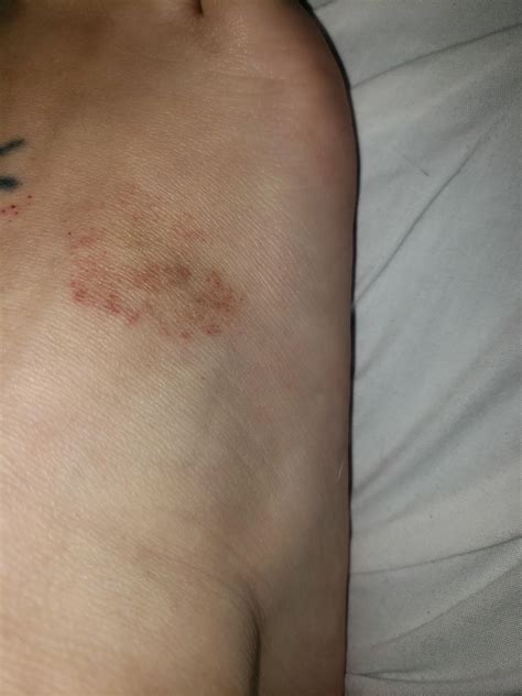 Red Brown Spots On My Foot Dr Says Its Age Spots But I M 31 R Diagnoseme