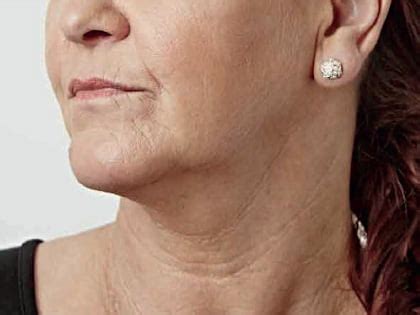 Jowls And Jawline Botox And Fillers Skinviva Manchester