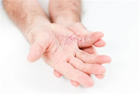 Scar Management Hand Therapy Centre