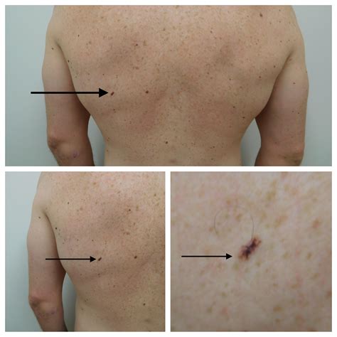 Skin Cancer Lesion On Back