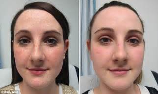 Exploring The Possibilities Of Plastic Surgery For Freckle Removal Types Effectiveness And