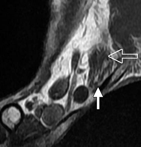 Multimodality Imaging Of Peripheral Neuropathies Of The Upper Limb And