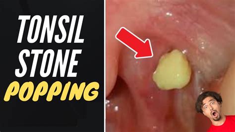 Tonsil Stone Popping 2021 What Are Tonsil Stones Youtube