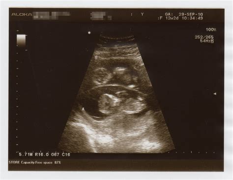 12 Weeks Ultrasound Flickr Photo Sharing