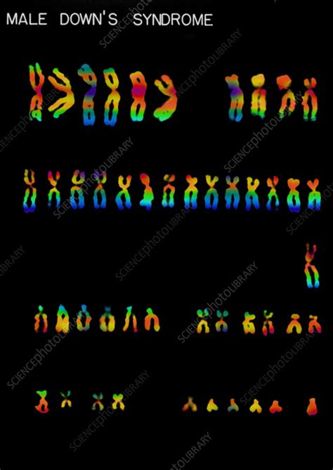 down s syndrome karyotype stock image c022 0522 science photo library