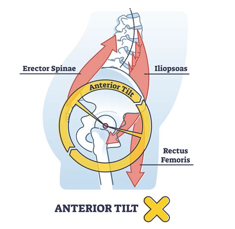 Anterior Pelvic Tilt 3 Stretches And 3 Exercises To Remedy Inspire Us