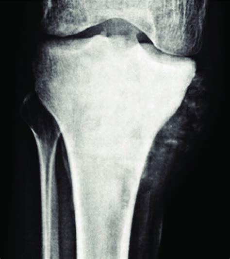 A Osteosarcoma Involving The Proximal Tibia Download Scientific Diagram