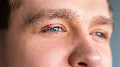 Eye Infections Symptoms Types Treatment And Prevention Online
