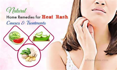 Top 23 Natural Home Remedies For Heat Rash Causes Amp Treatments Riset