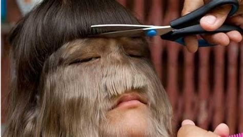 泰国11岁女孩满脸长毛像“美猴王”，被入选吉尼斯记录