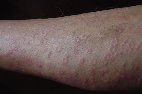 Rashes On Legs Dorothee Padraig South West Skin Health Care