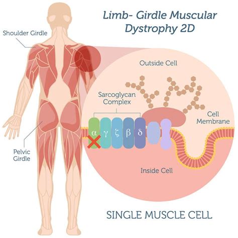 Limb Girdle Muscular Dystrophy Lgmd Symptoms Treatment