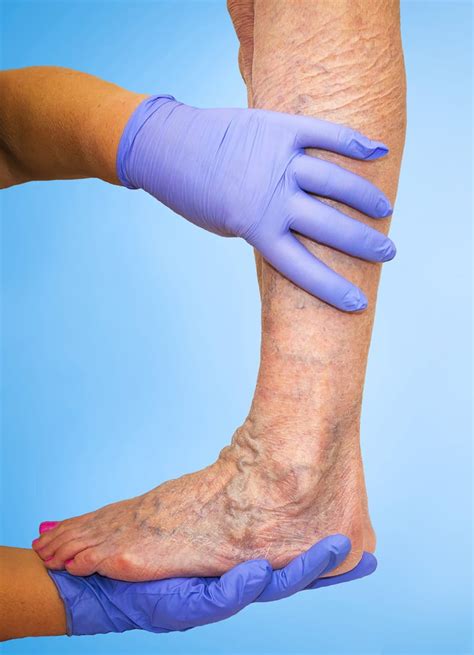 Deep Vein Thrombosis Blood Clots Archives The New Jersey Vein