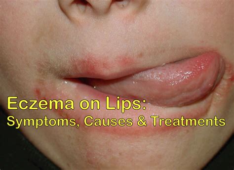 Eczema On Lips Symptoms Causes And Treatments Disfreeskin