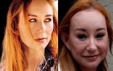 Tori Amos Plastic Surgery For Unnatural Looks