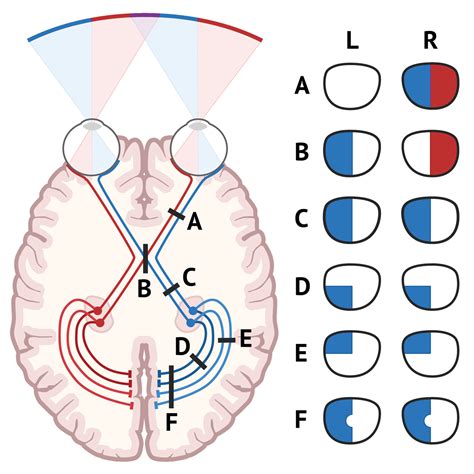 Visual Field Defects Visual Cortex Optic Neuritis Opt