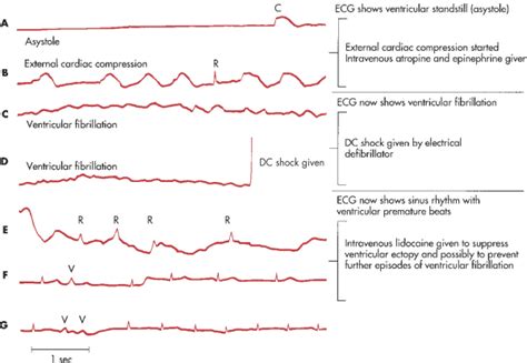 Cardiac Arrest And Sudden Cardiac Death Cardiac Rhythm Disturbances