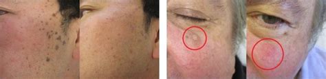 Benign Skin Growths Causes Treatment And Prevention Toronto