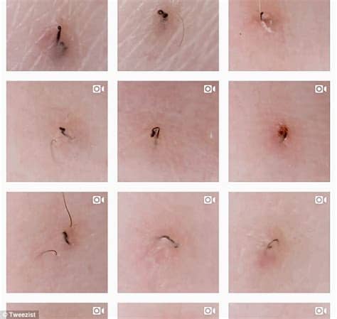 Having strange bumps or lumps appearing on your armpit or … Ingrown hair account Tweezist is your new guilty pleasure ...