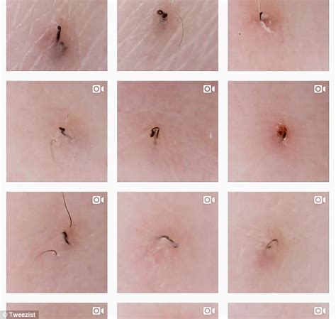An ingrown hair that appear in your armpit can be painful with a lot of problems. Ingrown hair account Tweezist is your new guilty pleasure ...
