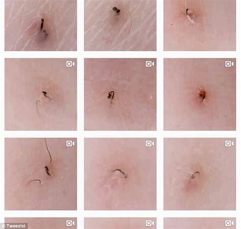 Ingrown hairs may be caused by improper what is an ingrown hair? Ingrown hair account Tweezist is your new guilty pleasure ...