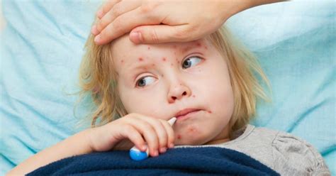 Baby Smallpox