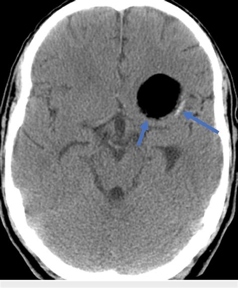 Figure 1 From An Atypical Case Of Intracranial Dermoid Cyst In An Adult