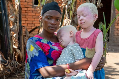 Qué Es El Albinismo Cuáles Son Sus Causas Y Cómo Tratarlo Infobae