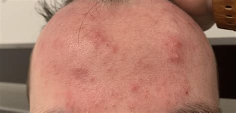 Acne Help For Flaky Red Inflamed Skin Usually Also Has Large