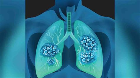 A Promising Treatment For Non Small Cell Lung Cancer Commonwealth Union
