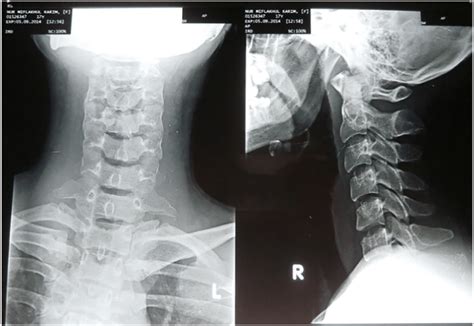 Ap And Lateral View Of Cervical Spine X Ray There Is No Fracture And