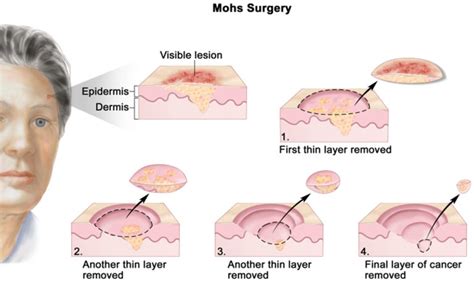 Mohs Micrographic Surgery Skin Cancer Advantages Complications