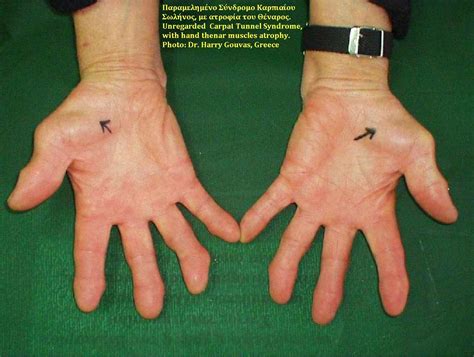 Filecarpal Tunnel Syndrome Thenar Atrophy