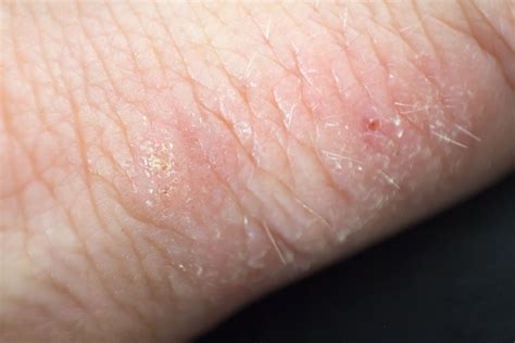Eczema Severe Itching Contact Dermatitis Scaly Rash