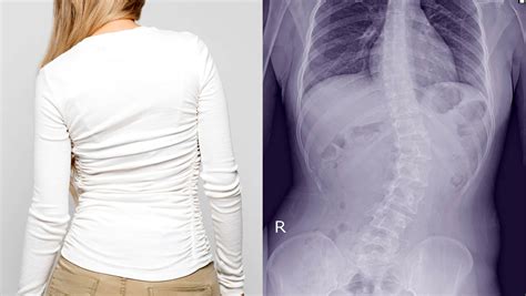 Chiropractic Care Corrects Scoliosis - Johnstown, CO Chiropractic Care