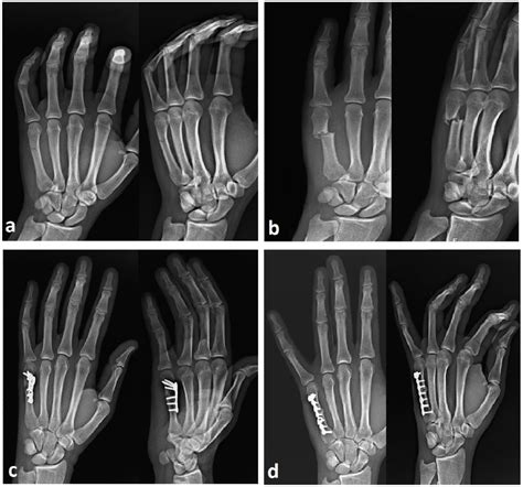 Metacarpal Shaft Fracture