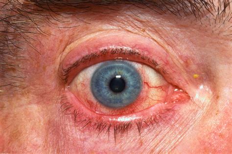 Wife's sexual fantasy before husband's eyes erotik film izle. What to do when the "eyes" have it - The Clinical Advisor