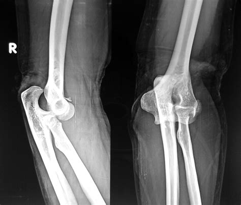 Radiodiagnosis Imaging Is Amazing Interesting Cases Elbow Dislocation