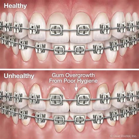 Oral Hygiene Toombs Orthodontics Prairie Village Ks