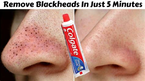 Here in this article, we come with natural methods which are available easily in the kitchen or else market for 1. How To Remove Blackheads Permanently From Face & Nose In ...