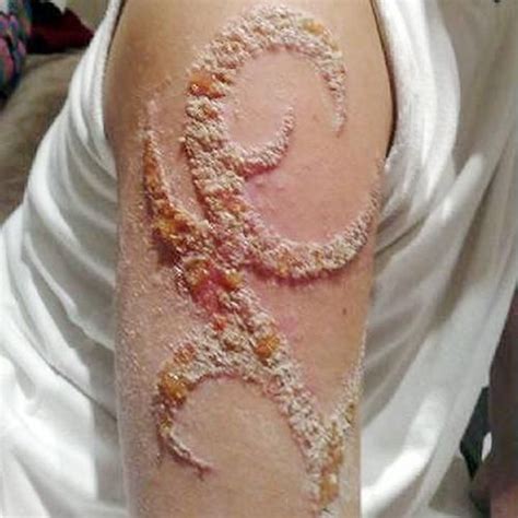 Worst Tattoo Infection Ever Paperblog Tattoos Gone Wrong Infected