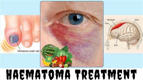 Types Of Haematoma Medical Treatment For A Hematoma Clickbank