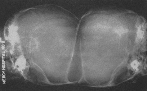 Successful Separation Of Craniopagus Twins In Journal Of Neurosurgery