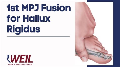 1st Mpj Fusion For Hallux Rigidus Weil Foot And Ankle Institute Youtube