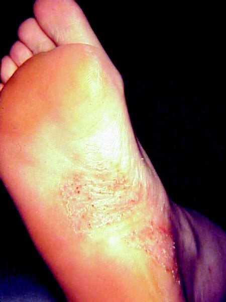 How To Detect And Treat Tinea Pedis Podiatry Today