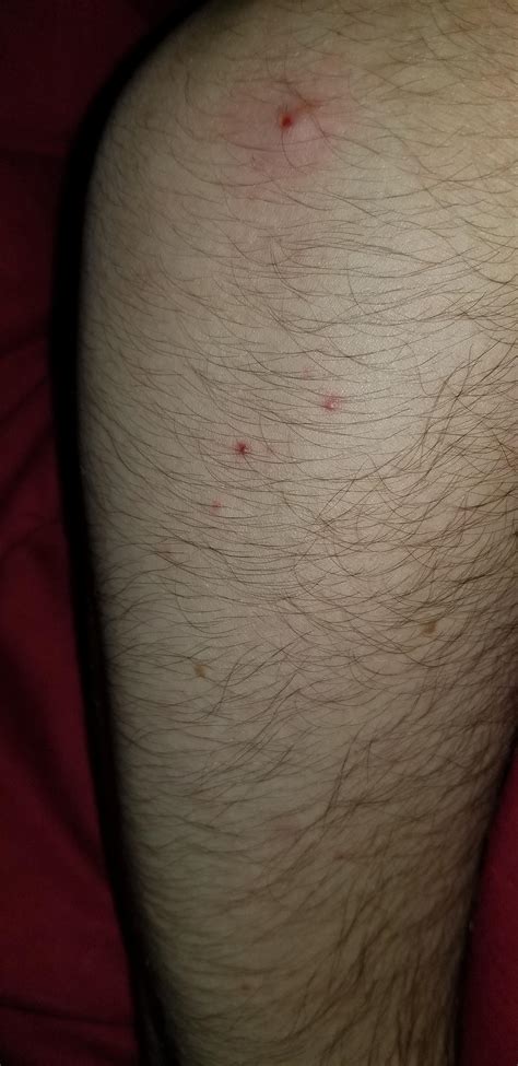Been Getting These Zit Like Bumps On My Arm For A While Now Is This